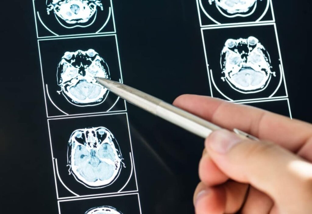 Acidente vascular cerebral (AVC): o que é, tipos e possíveis sequelas. O cérebro após um derrame.